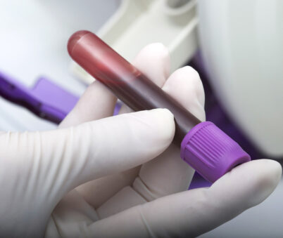 Hepatitis C RNA Viral Load Blood Test