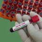 Blood sample for Anti HBc total (Total hepatitis B core antibody) testing. Hepatitis b virus core antigen.