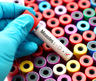 Measles
