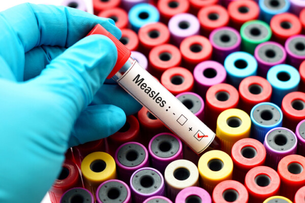 Blood sample positive with Measles virus