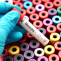 Blood sample positive with Measles virus