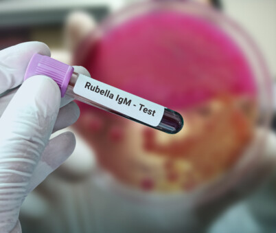 Rubella