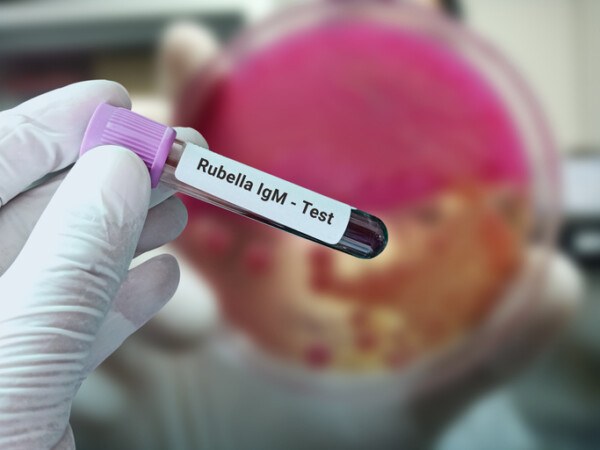 Rubella